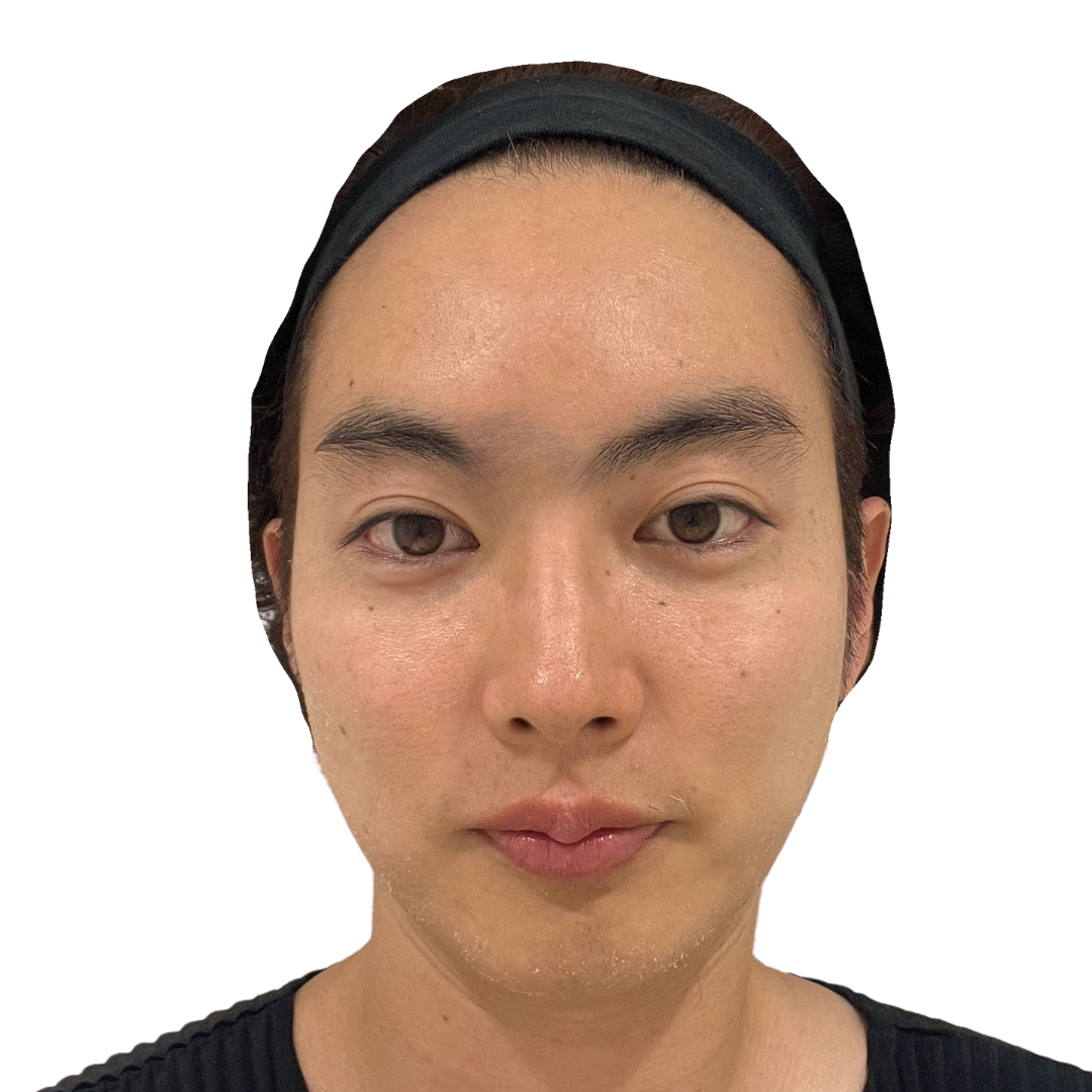 マヌカフェイシャル（ダーマペン4）